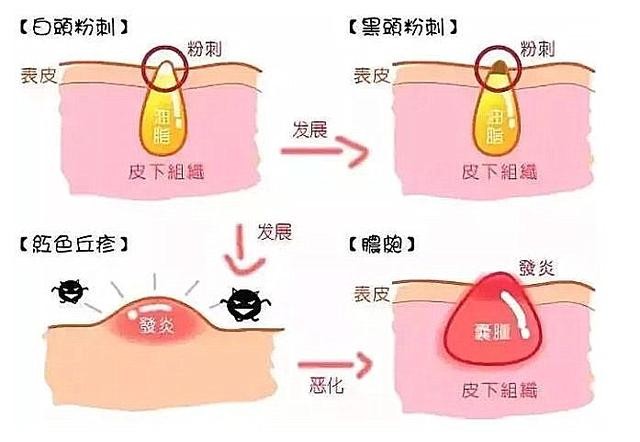 什么是粉刺和闭口图片（粉刺的形成原因及解决办法）