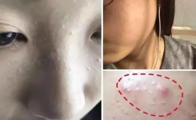 ​什么是粉刺和闭口图片（粉刺的形成原因及解决办法）