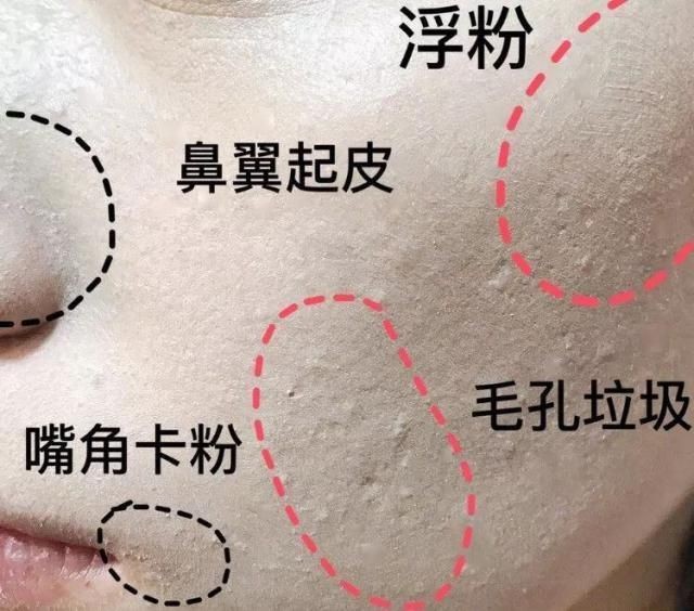 什么是粉刺和闭口图片（粉刺的形成原因及解决办法）