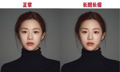 ​男朋友会嫌弃女朋友脸上有痘痘吗