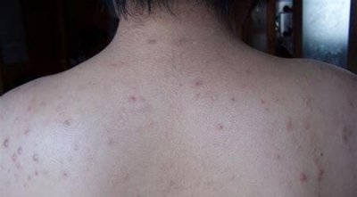 ​女生前胸后背长痘痘的原因(为什么很多女生前胸后背长痘痘?)