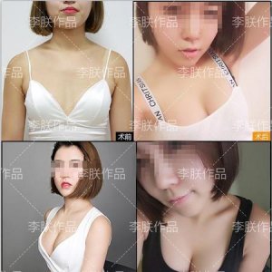 ​如何快速丰胸简单有效的方法(快速丰胸的小方法)