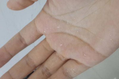 ​手上老长小水泡有时还特别痒 手上老是长小水泡很痒怎么回事