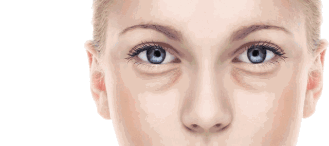 下眼袋松弛怎么办简单去眼袋方法（女人长眼袋太显老）(6)