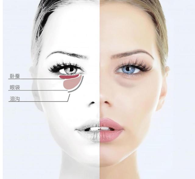 下眼袋松弛怎么办简单去眼袋方法（女人长眼袋太显老）(5)
