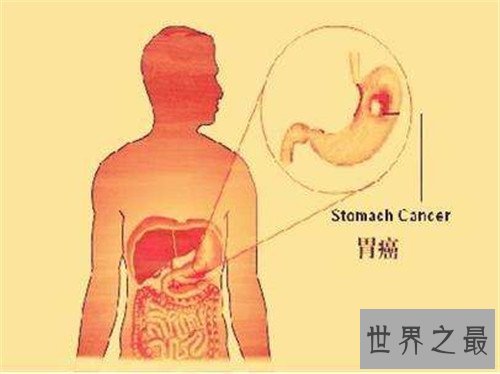 胃癌的早期症状是什么 怎样治疗胃癌有效果