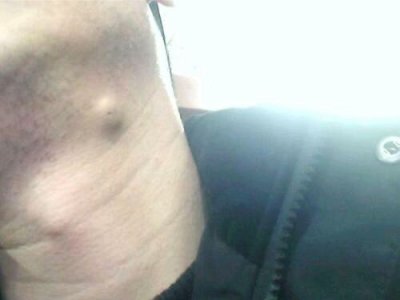 ​粉瘤是什么（“粉瘤”是什么？如何处理？怎么预防？）