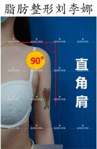 ​什么是直角肩？