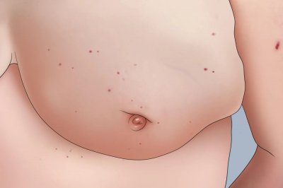 ​乳腺癌早期症状图片